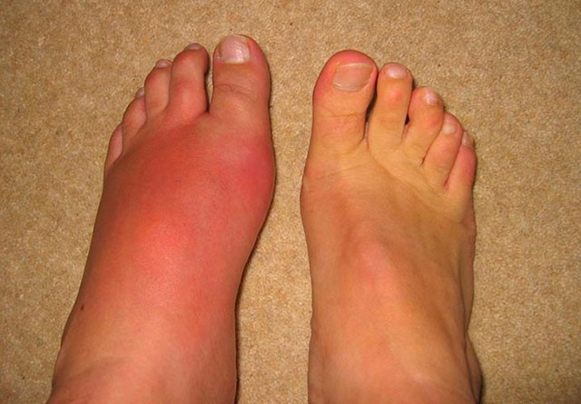 Viêm khớp bàn chân gây đau nhức khó chịu cho người bệnh
