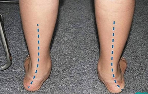 Bàn chân bẹt là một dạng di tật xuất hiện nhiều ở trẻ nhỏ