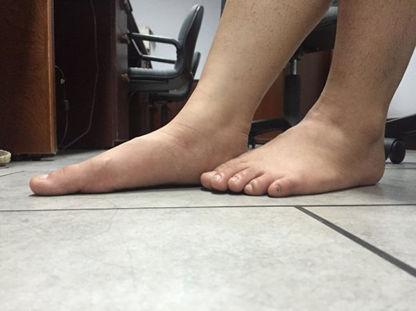 Người có bàn chân bẹt là bàn chân không có vị trí lõm khi đứng thẳng
