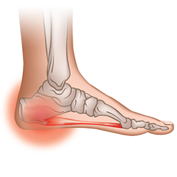 Đau gót chân là bệnh lý xảy ra chủ yếu do các chấn thương