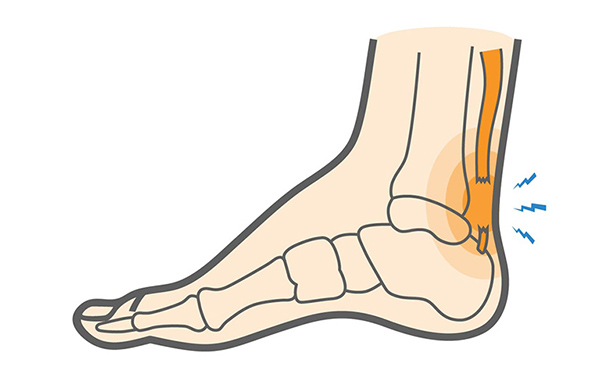 Đứt gót chân làm mất sự liên kết giữa xương và cơ bắp, gây đau nhức