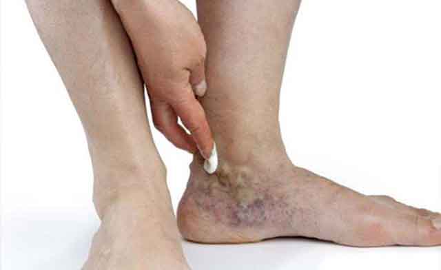 Tràn dịch khớp cổ chân là bệnh lý phổ biến