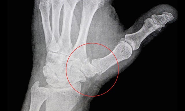 Thoái hóa khớp ngón tay là dấu hiệu tổn thương sụn khớp