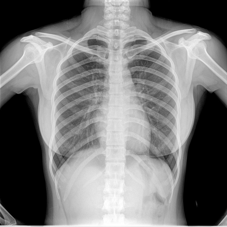 Phương pháp chụp X-quang chẩn đoán trượt đốt sống