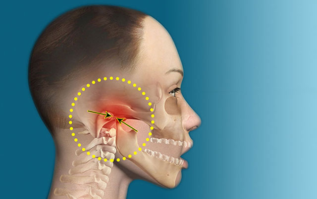 Rối loạn khớp thái dương hàm là bệnh lý gây đau khó chịu vùng khớp mặt