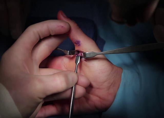 Phẫu thuật điều trị ngón tay cò súng có thể được mổ mở hoặc mổ kín