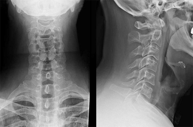  Chụp X-quang giúp chẩn đoán bệnh thoái hóa cột sống
