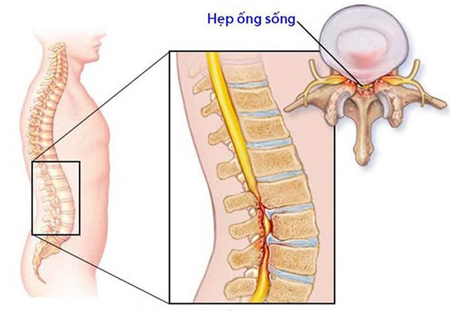 Hẹp ống sống lưng gây đau nhức, khó chịu vùng lưng