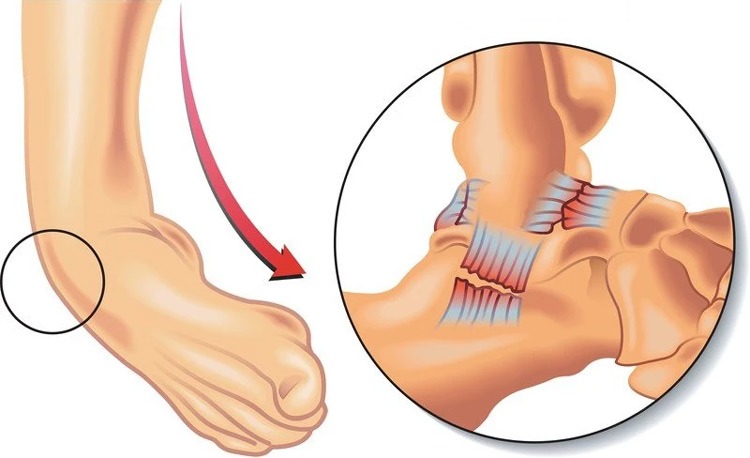  Tùy từng tổn thương mà sẽ được phân thành các mức độ trẹo cổ chân khác nhau