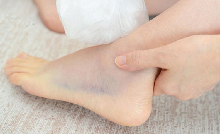  Trẹo cổ chân - Tình trạng uốn cong, xoay vặn bàn chân quá mức làm mất tính ổn định của khớp