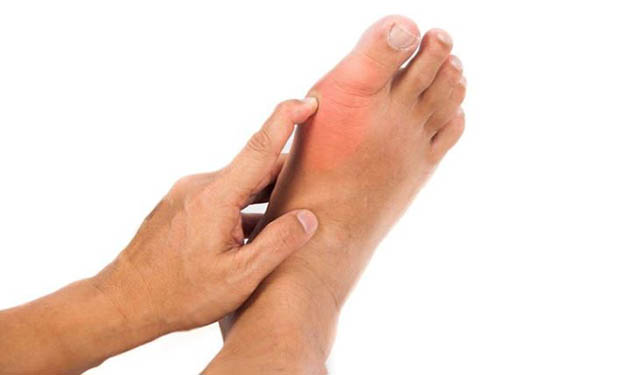 Viêm khớp ngón chân cái thường đi kèm hiện tượng sưng đỏ, đau nhức