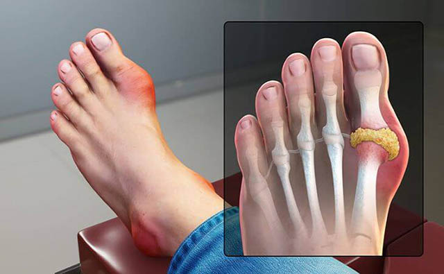 Gout là một trong những bệnh lý gây đau ngón chân cái
