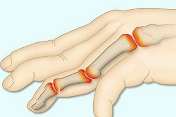 Thoái hóa khớp có thể hình thành viêm khớp ngón tay