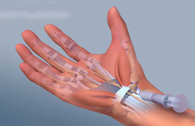Tràn dịch khớp cổ tay là gì? Nguyên nhân gây bệnh và cách điều trị